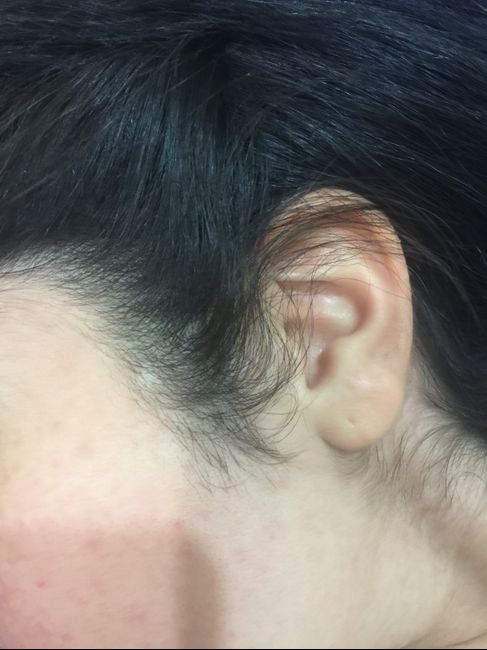  Depilación Láser en toda la cara😱👩 - 1