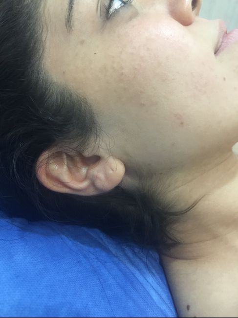  Depilación Láser en toda la cara😱👩 - 2