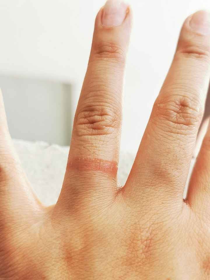 ¿Alergia a la argolla de matrimonio? 😨 - 1