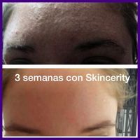 Adiós a mis granitos de acné y puntos negros - 1