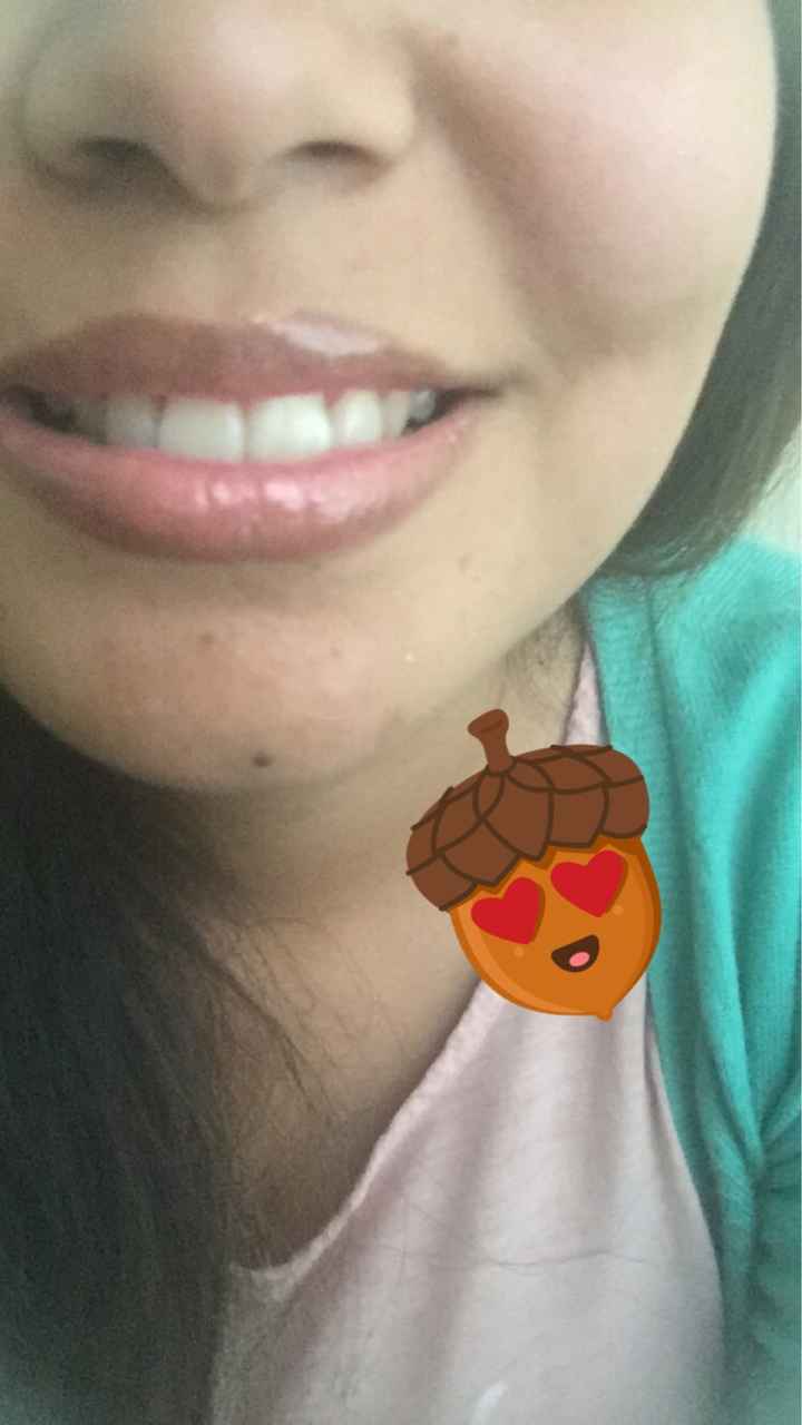  Adiós brackets!!! - 1