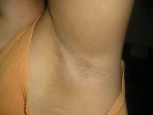 Help me :( axilas obscuras - 3