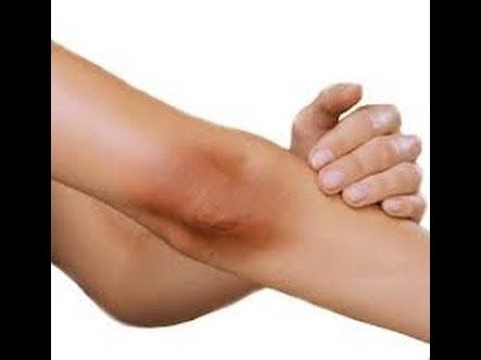 Help me :( axilas obscuras - 8