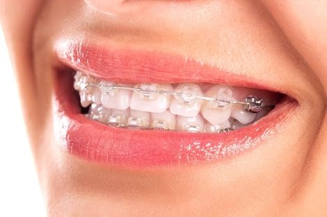 Novia con brackets?! <img class=