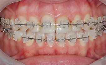 Novia con brackets?! <img class=