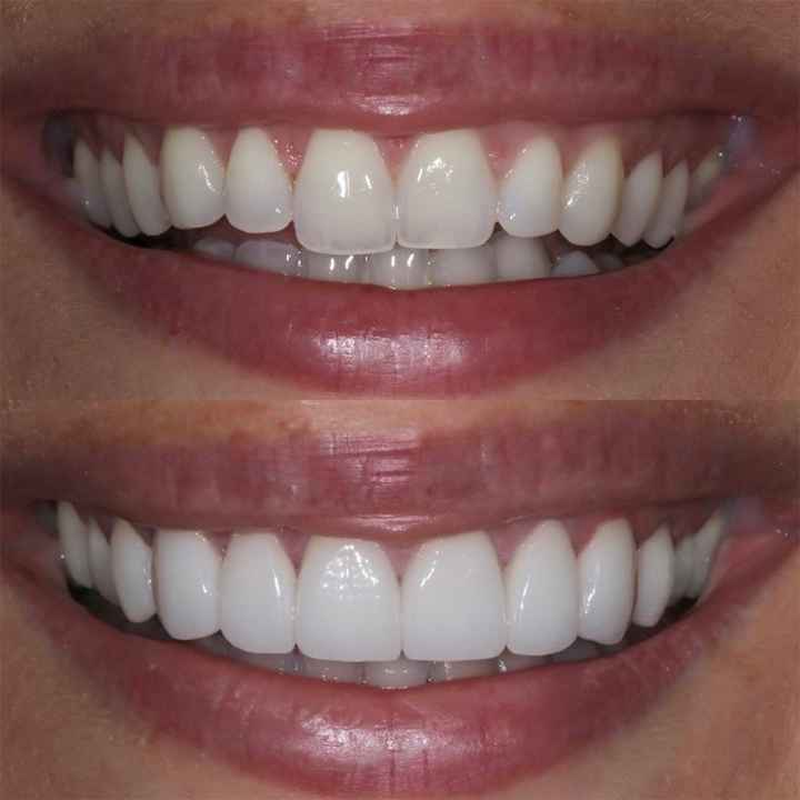 Cuidados dentales antes de tu boda 🦷👰🏼‍♀️🤵🦷 - 4