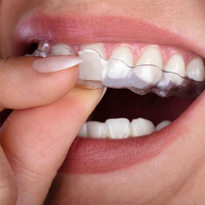 Cuidados dentales antes de tu boda 🦷👰🏼‍♀️🤵🦷 - 5