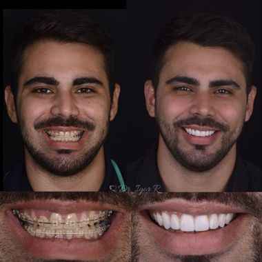 Lentes de contactos dentales para la boda - 1