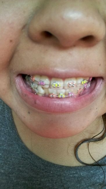 Novia con brackets?! :( - 1