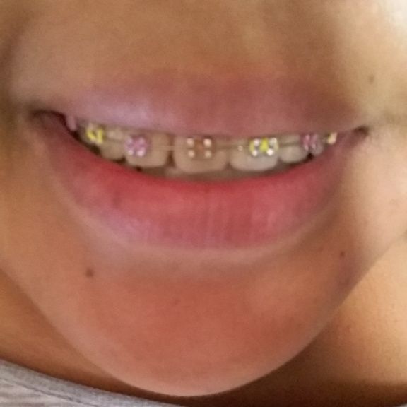 Novia con brackets?! :( - 3