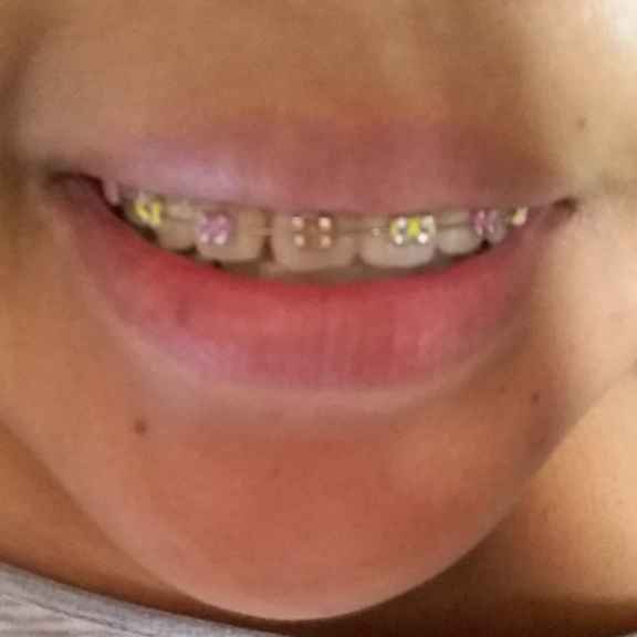 Novia con brackets?! :( - 3
