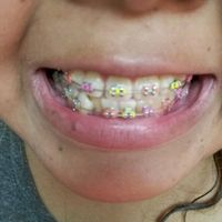 Novia con brackets?! :( - 1