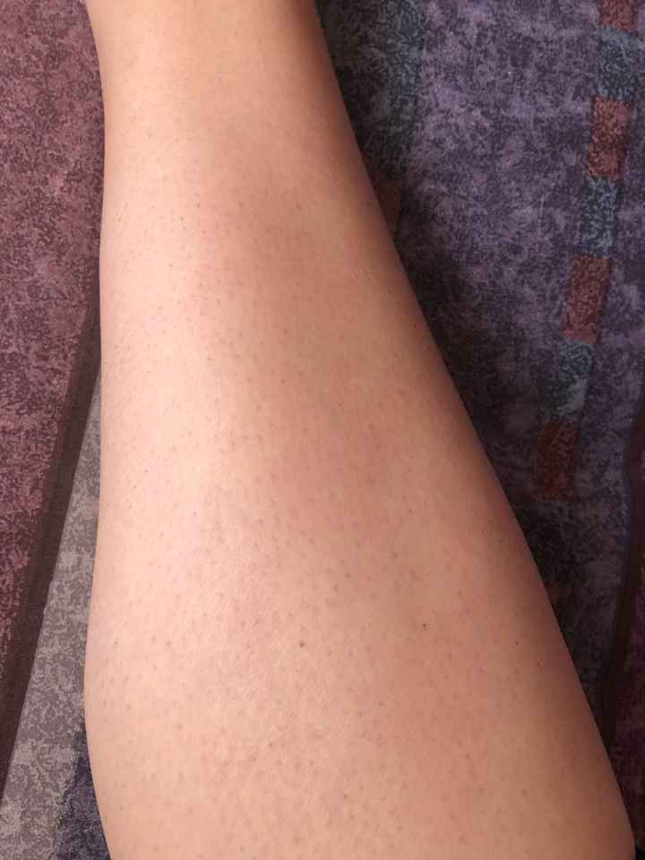 Mi experiencia con la depilación permanente - 1