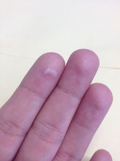 AMPOLLA DEDO ÍNDICE