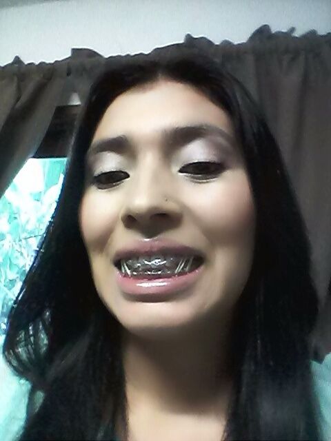 En la recta final de mis espantosos braquets  - 5