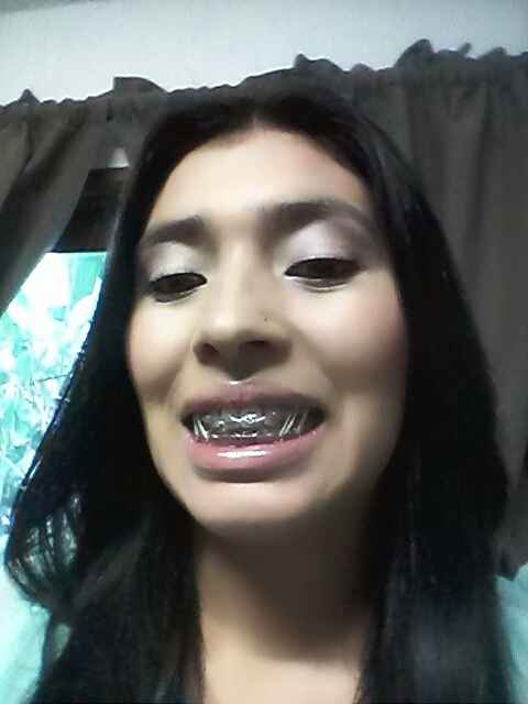 En la recta final de mis espantosos braquets  - 5