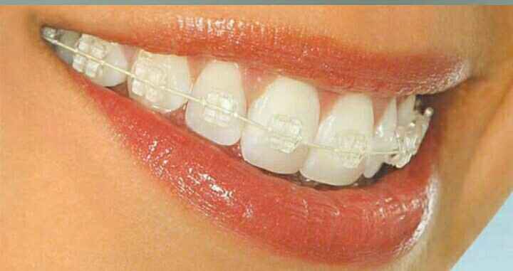 Novia con brackets 😬 - 1