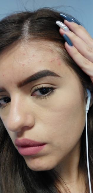 Ayudaaaa!! Me salió acné :( 2