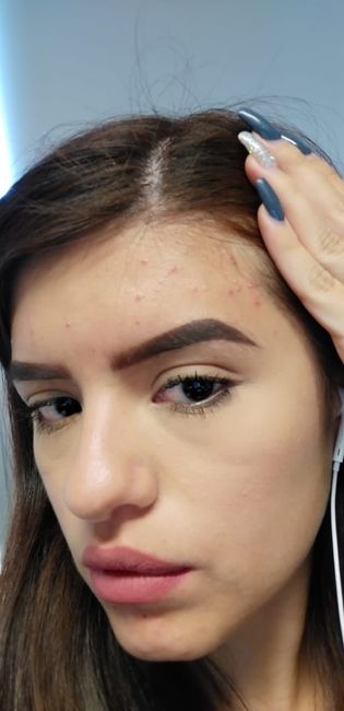 Ayudaaaa!! Me salió acné :( 3