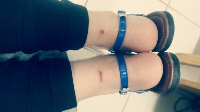 Asi quedaron mis pies 😭😭 - 2