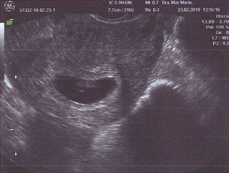 Primer eco de mi bebé 