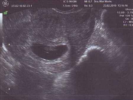 Primer eco de mi bebé 