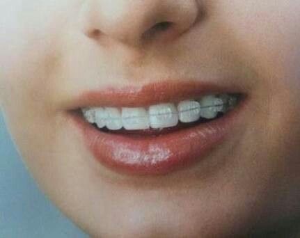 ¡novias con brackets! - 4