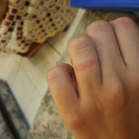 Alergia al anillo de matrimonio? :( - 2