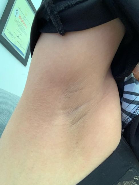 Consejos para el cuidado de la piel (axilas) 1