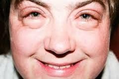 ojos hinchados por llorar