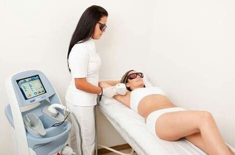 Depilación laser - 3