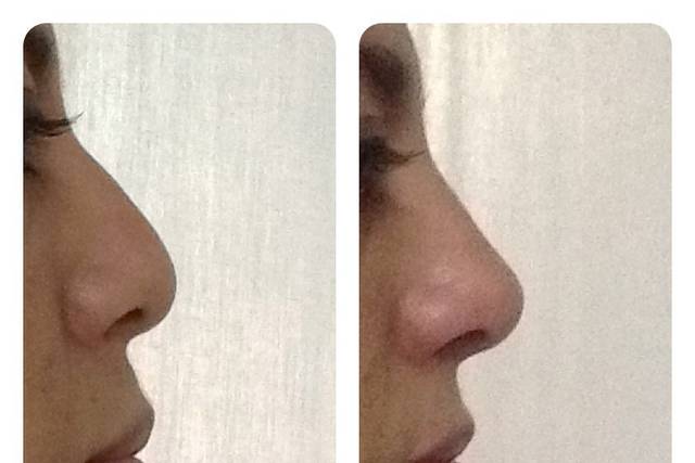 Nariz bella sin cirugía