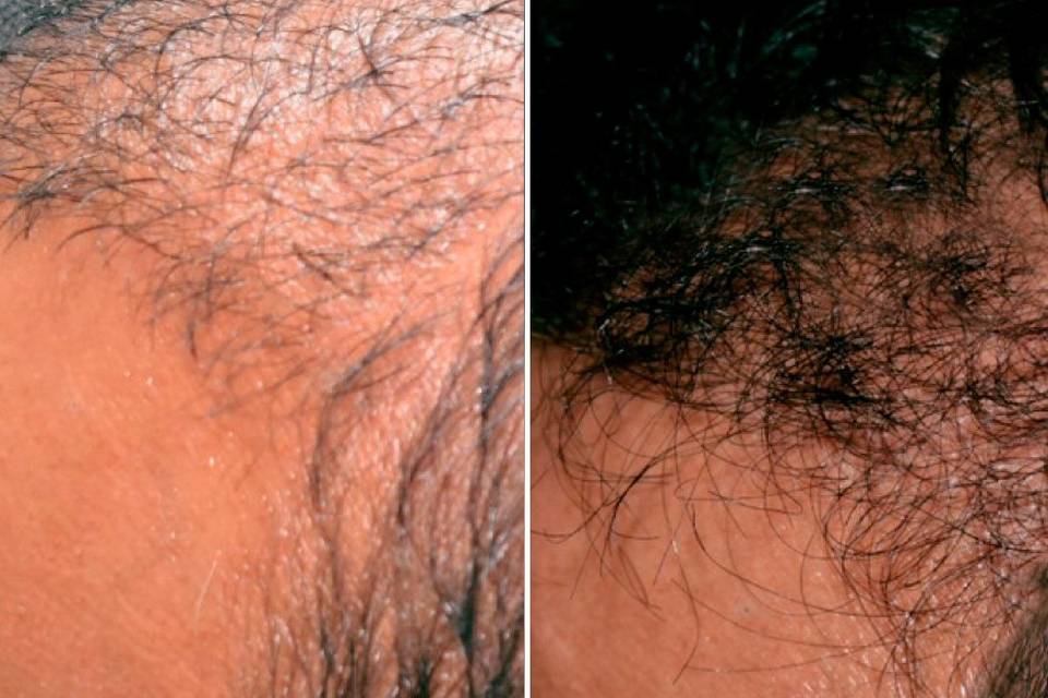 Tratamientos para alopecia