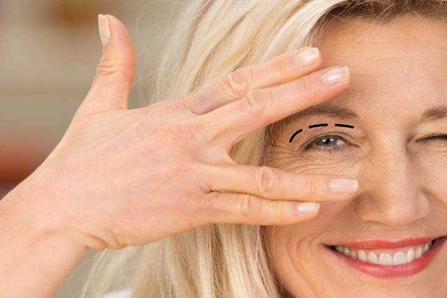 Blefaroplastia superior