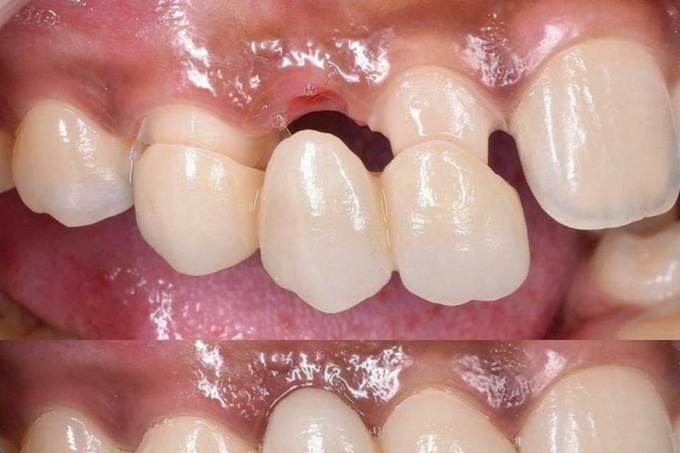 Puentes de zirconia