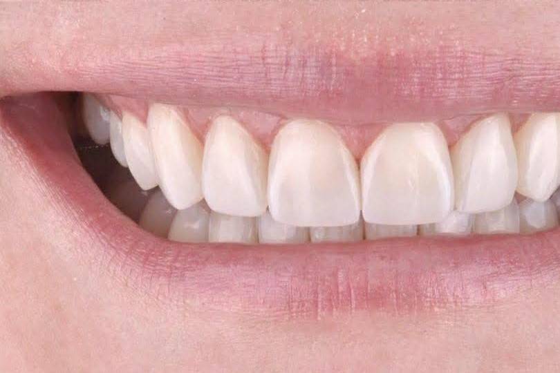 Diseño de sonrisa