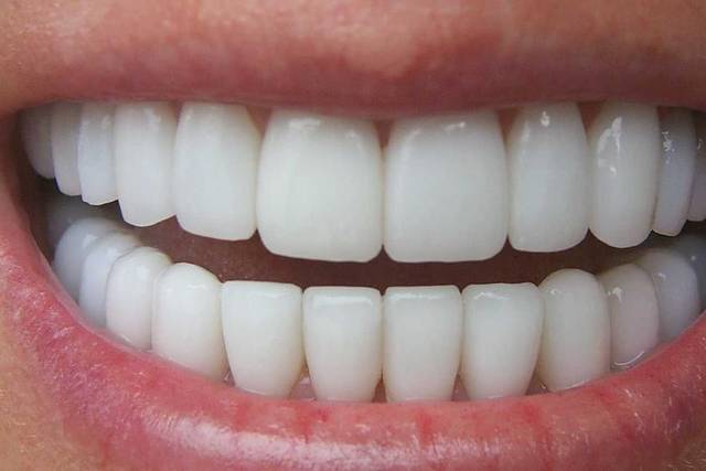 Blanqueamiento dental